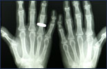 Xray of hands